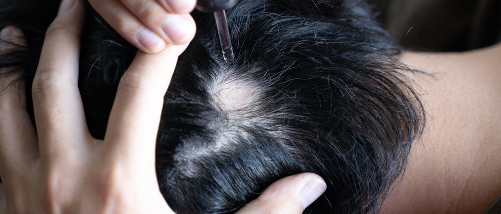 Alopecia Areata Treatment - Adore Skin Clinic