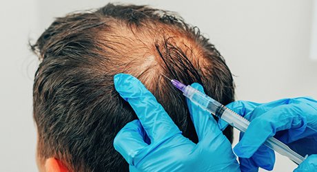 PRP Hair fall treatment near me