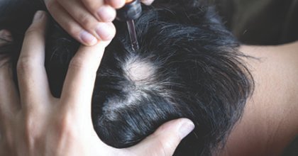 Alopecia Areata Procedure Treatment