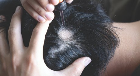 Alopecia Areata